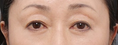 下眼瞼手術と目の下の脂肪再配置手術、中顔面リフトアップ。私に合った目の下のアンチエイジングは？（形成外科専門医 タク・ウヒョン） 사진 4