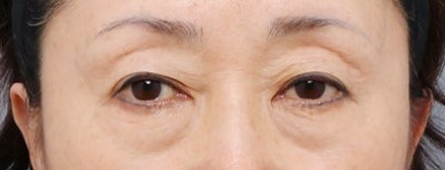 下眼瞼手術、眼袋脂肪重置手術、中臉拉提：哪種眼下抗衰老手術適合我？(整形外科專科醫師 卓佑賢) 사진 3