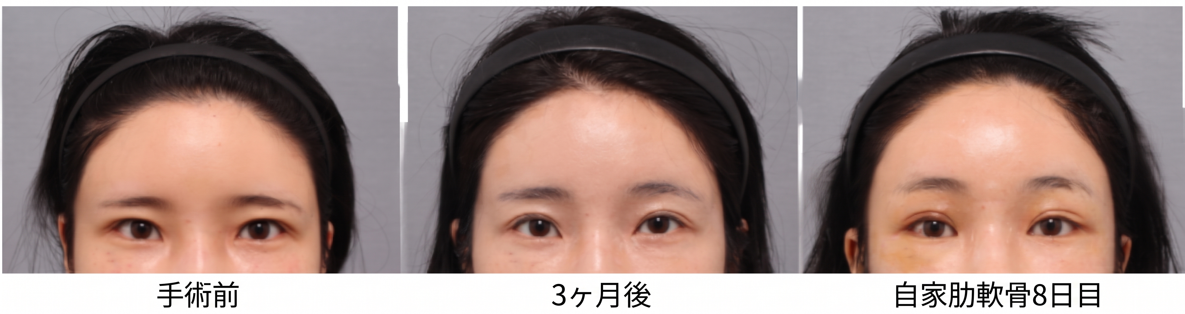 額リフトの再手術は可能ですか？回数・時期・方法まで美容外科専門医が解説します 사진 6