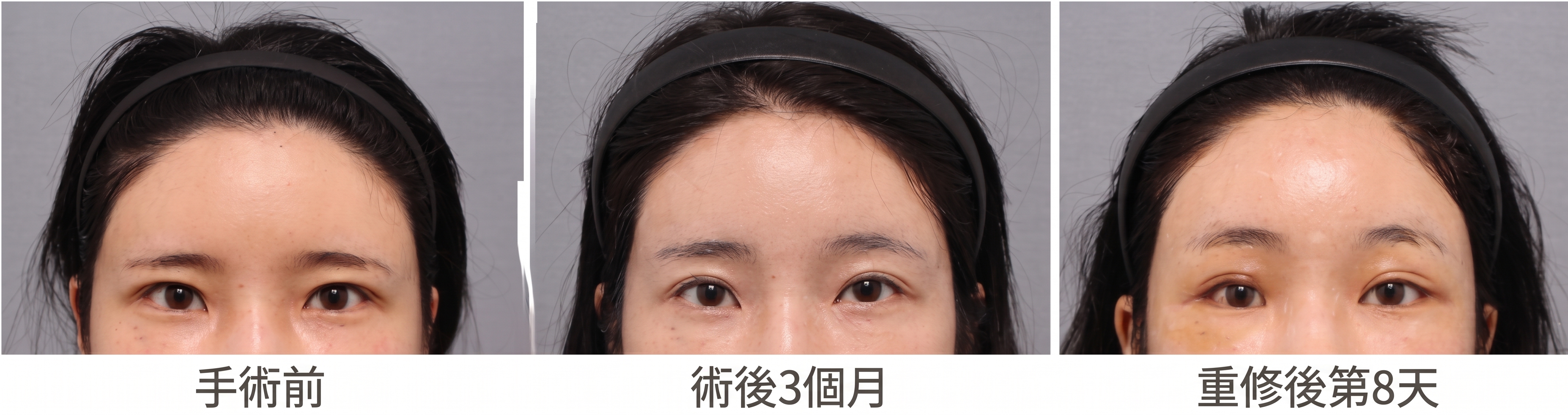 額頭拉提重修手術可行嗎?整形外科專科醫師為您說明次數、時機與方法 사진 6