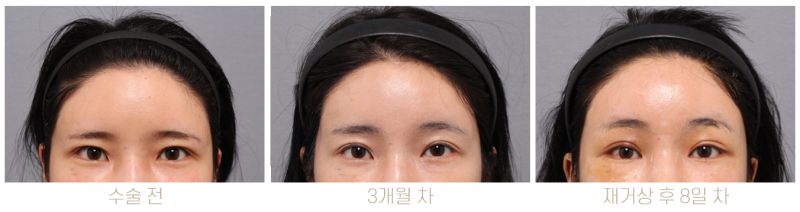 이마거상 재수술 가능한가요? 횟수·시기·방법까지 성형외과 전문의가 설명드립니다 사진 6