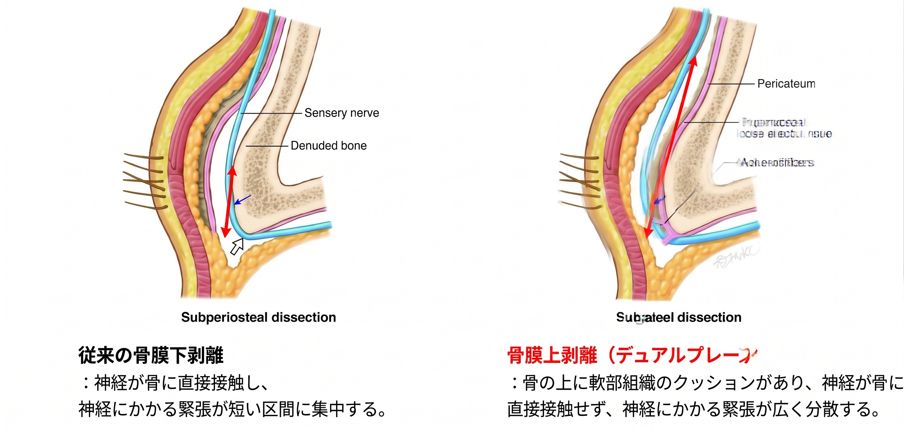 額リフトの再手術は可能ですか？回数・時期・方法まで美容外科専門医が解説します 사진 4