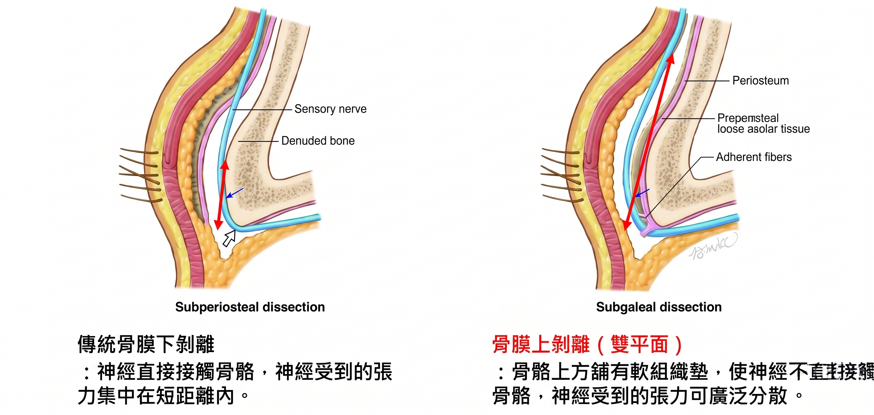 額頭拉提重修手術可行嗎?整形外科專科醫師為您說明次數、時機與方法 사진 4