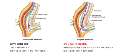 이마거상 재수술 가능한가요? 횟수·시기·방법까지 성형외과 전문의가 설명드립니다 사진 4