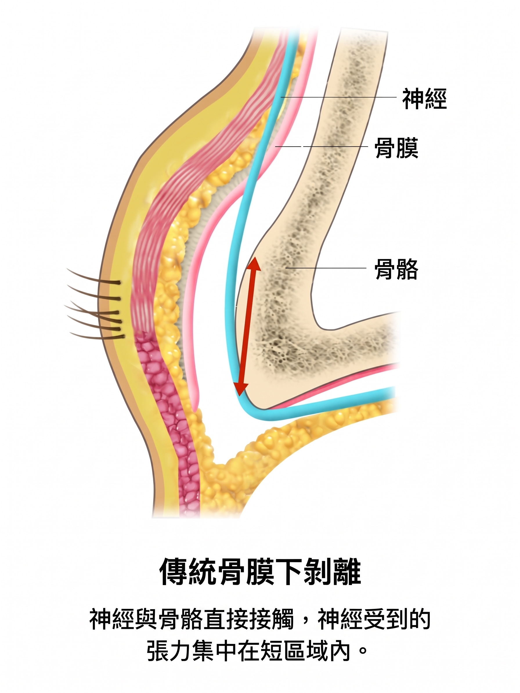 額頭拉皮・提眉手術，只是把眉毛拉高就夠了嗎？手術層次與保護神經的核心關鍵 | Taylor整形外科 사진 5