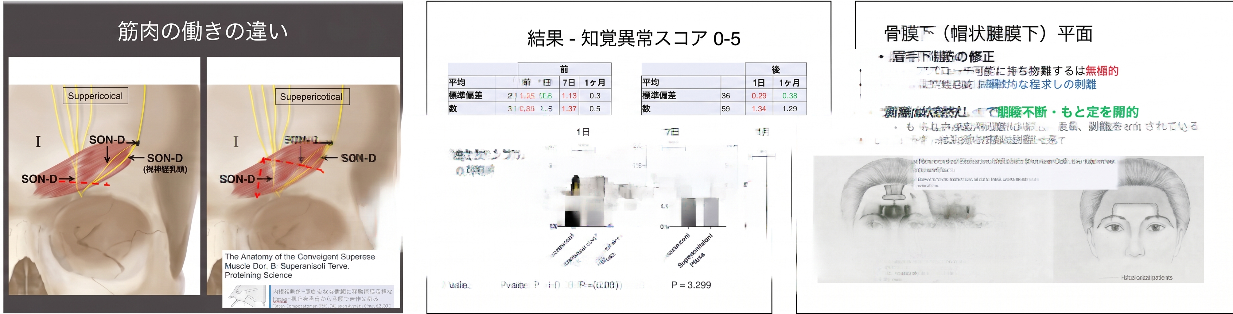額リフト・眉下垂改善、眉毛を引き上げるだけで十分でしょうか?手術層と神経保護の重要ポイント | テイラー美容外科 사진 2