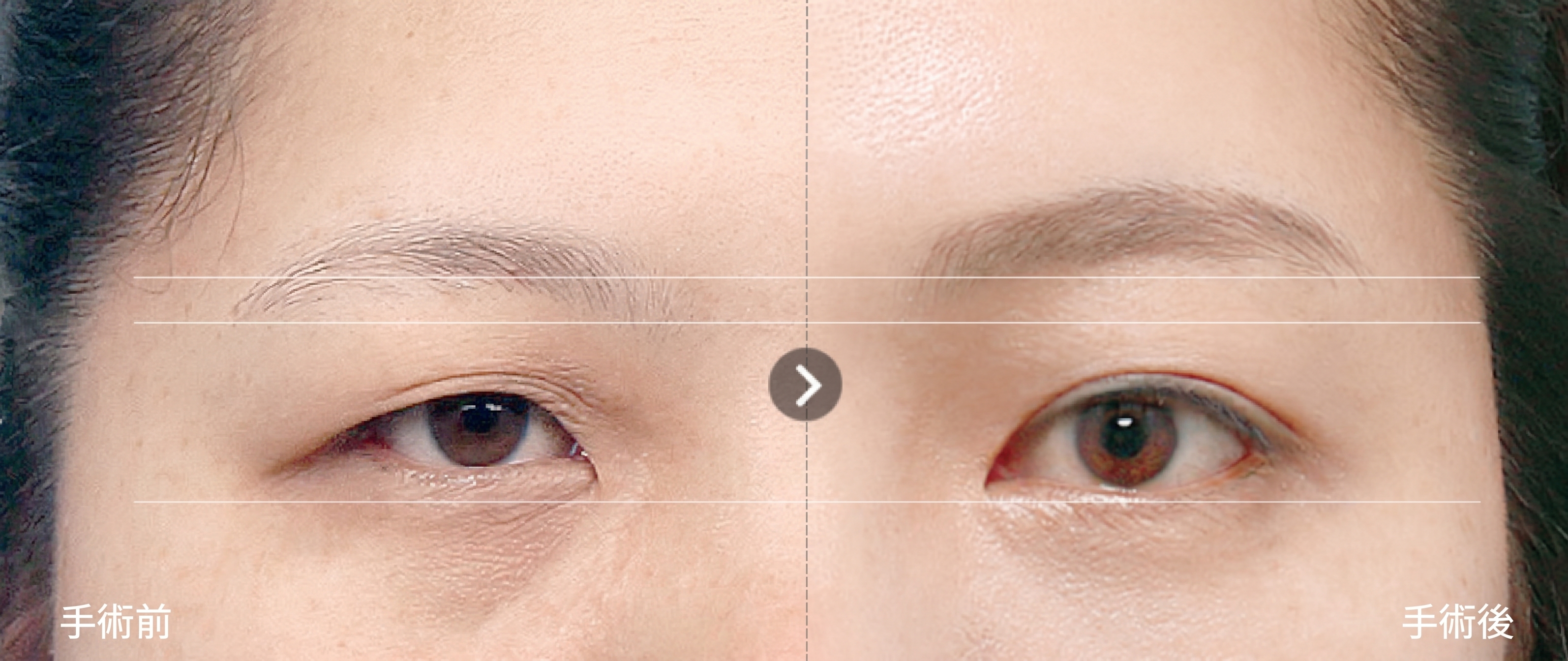 額頭拉皮・提眉手術，只是把眉毛拉高就夠了嗎？手術層次與保護神經的核心關鍵 | Taylor整形外科 사진 3
