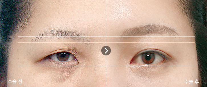 이마거상술·이마거상, 눈썹만 올리면 끝일까요? 수술층과 신경 보호의 핵심 | 테일러성형외과 사진 3