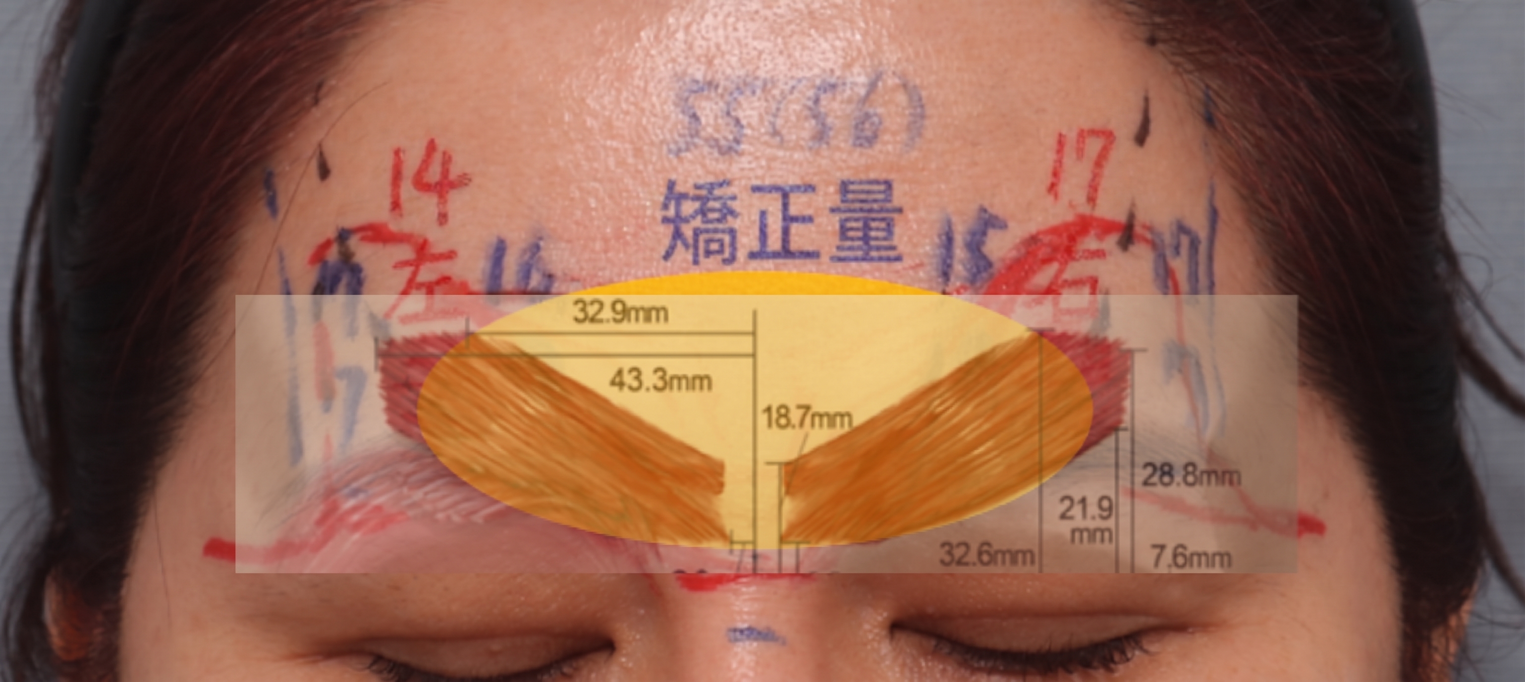 減少前額拉皮副作用的雙平面手術法 — 內視鏡前額拉皮臨床研究結果公開 | Taylor 整形外科 사진 6