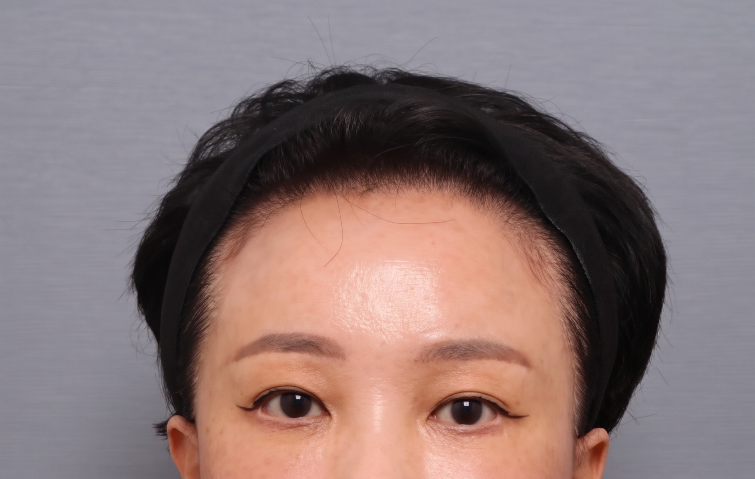 減少前額拉皮副作用的雙平面手術法 — 內視鏡前額拉皮臨床研究結果公開 | Taylor 整形外科 사진 3
