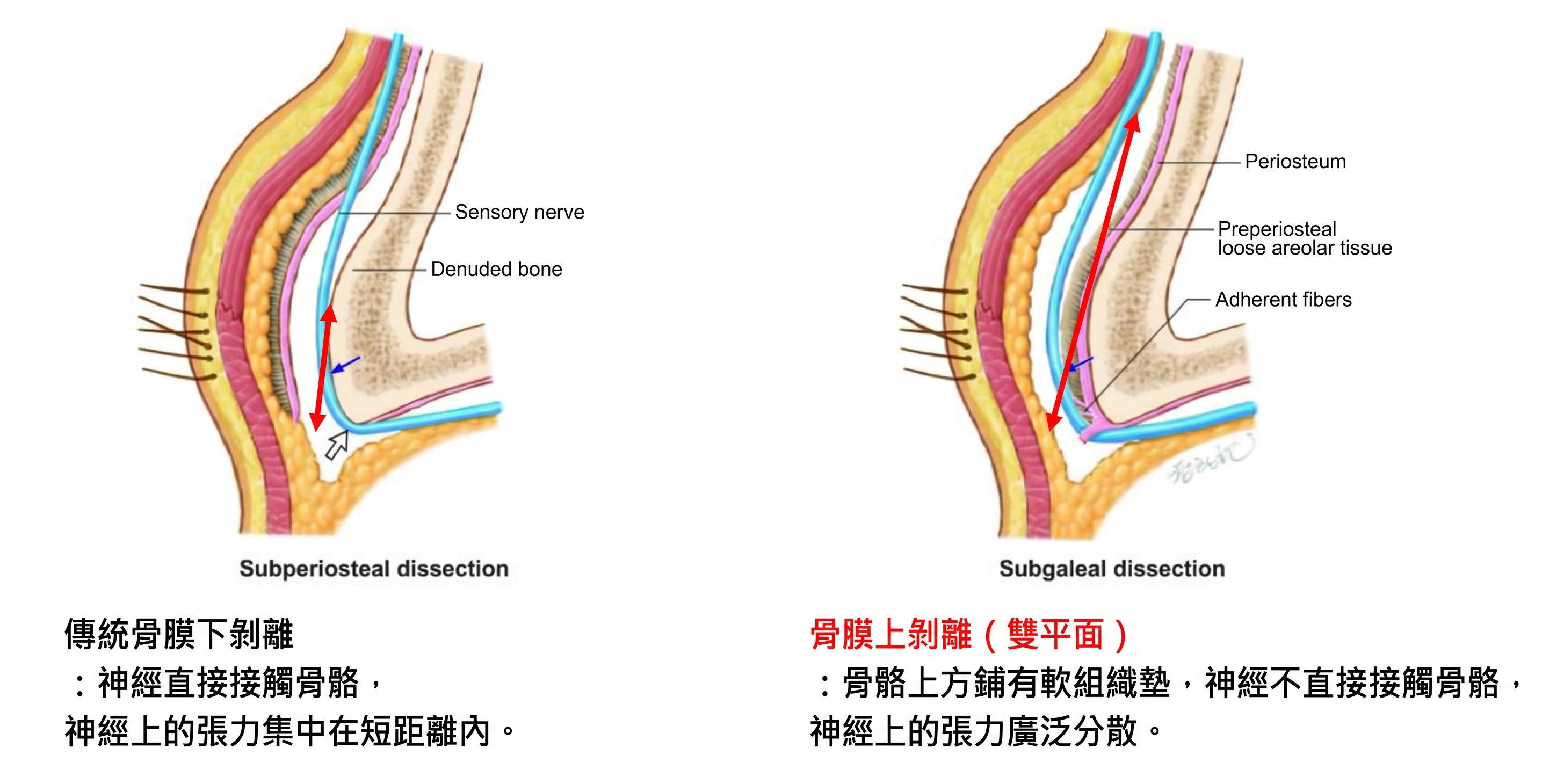減少前額拉皮副作用的雙平面手術法 — 內視鏡前額拉皮臨床研究結果公開 | Taylor 整形外科