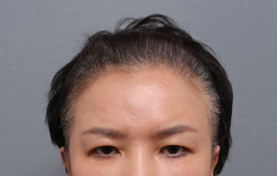 이마거상 부작용을 줄이는 듀얼플레인 수술법 — 내시경이마거상 임상 연구 결과 공개 | 테일러성형외과 사진 2