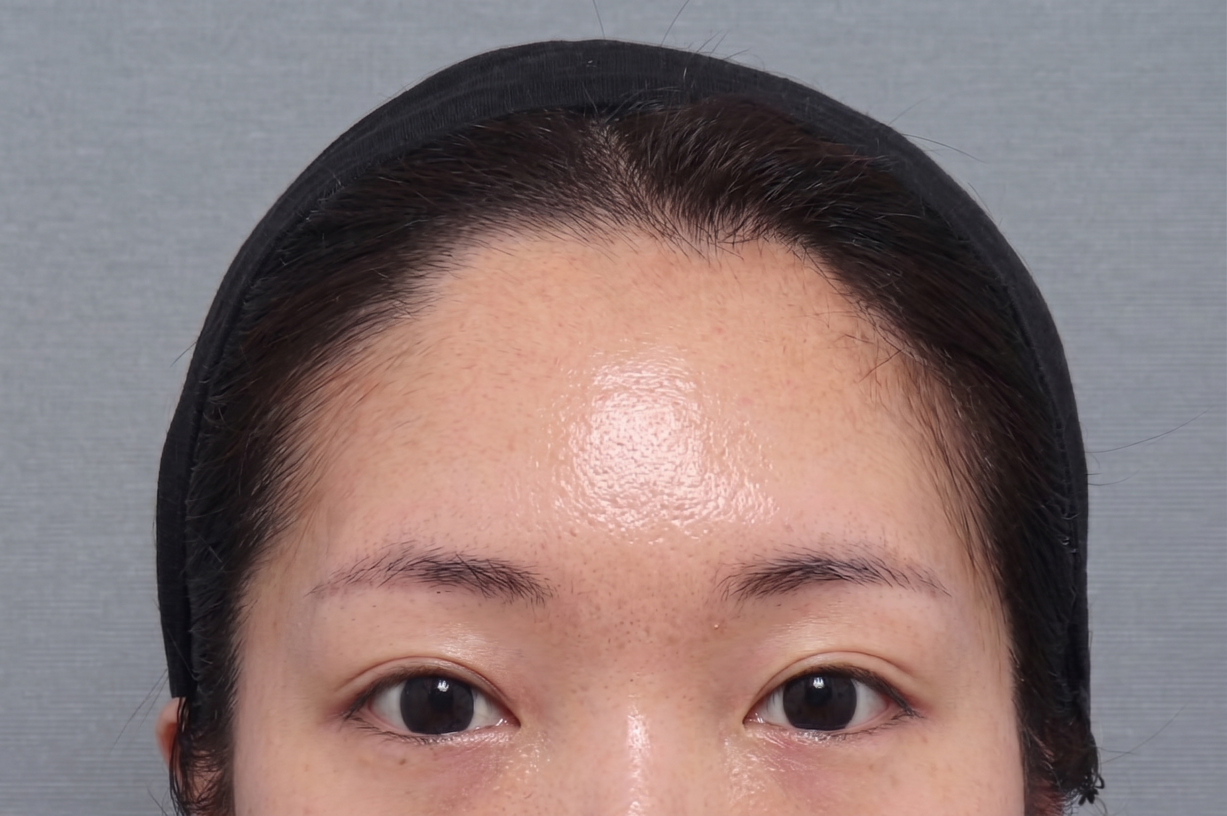 內視鏡前額拉皮剝離範圍應該到哪裡?從肌肉、神經到固定方式,深入解析前額拉皮核心關鍵 | Taylor整形外科 사진 2