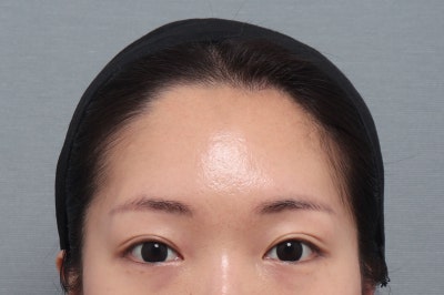 이마거상 박리 범위, 어디까지 해야 할까요? 근육·신경·고정까지 이마거상술의 핵심을 설명합니다 | 테일러성형외과 사진 2