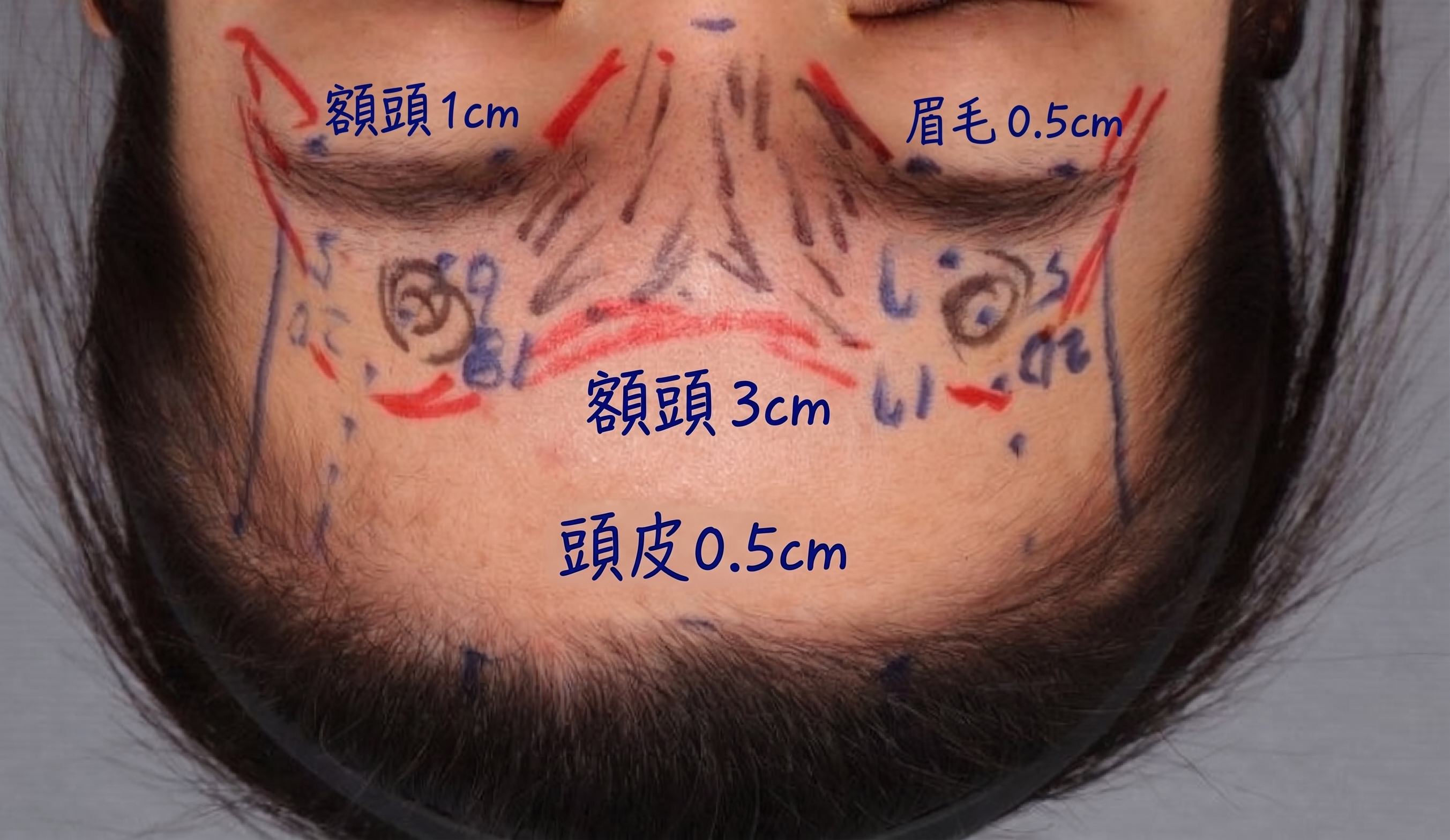 內視鏡前額拉皮剝離範圍應該到哪裡?從肌肉、神經到固定方式,深入解析前額拉皮核心關鍵 | Taylor整形外科 사진 6
