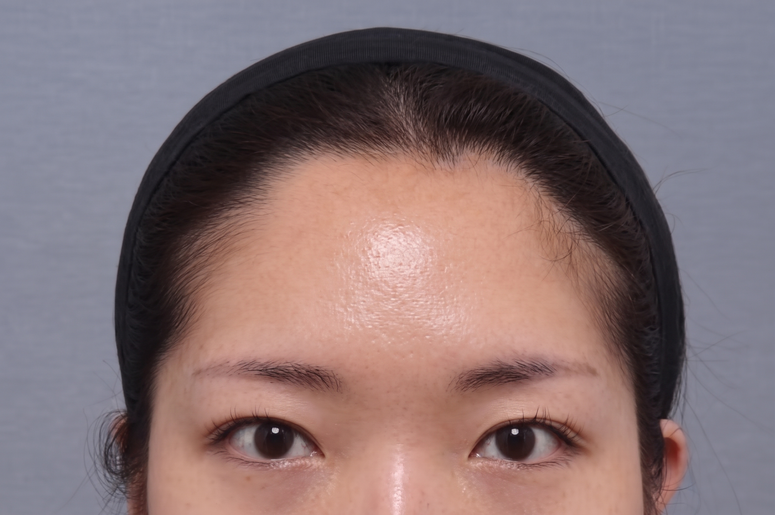 內視鏡前額拉皮剝離範圍應該到哪裡?從肌肉、神經到固定方式,深入解析前額拉皮核心關鍵 | Taylor整形外科
