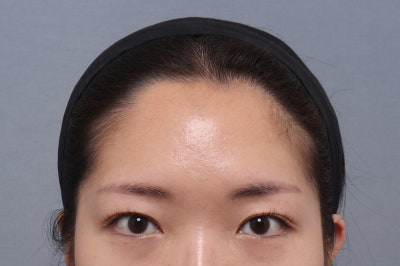 이마거상 박리 범위, 어디까지 해야 할까요? 근육·신경·고정까지 이마거상술의 핵심을 설명합니다 | 테일러성형외과