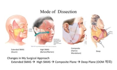 안면거상술에서 SMAS 외에 무엇을 함께 봐야 하는가 - Integrated Tissue Control | 테일러성형외과
