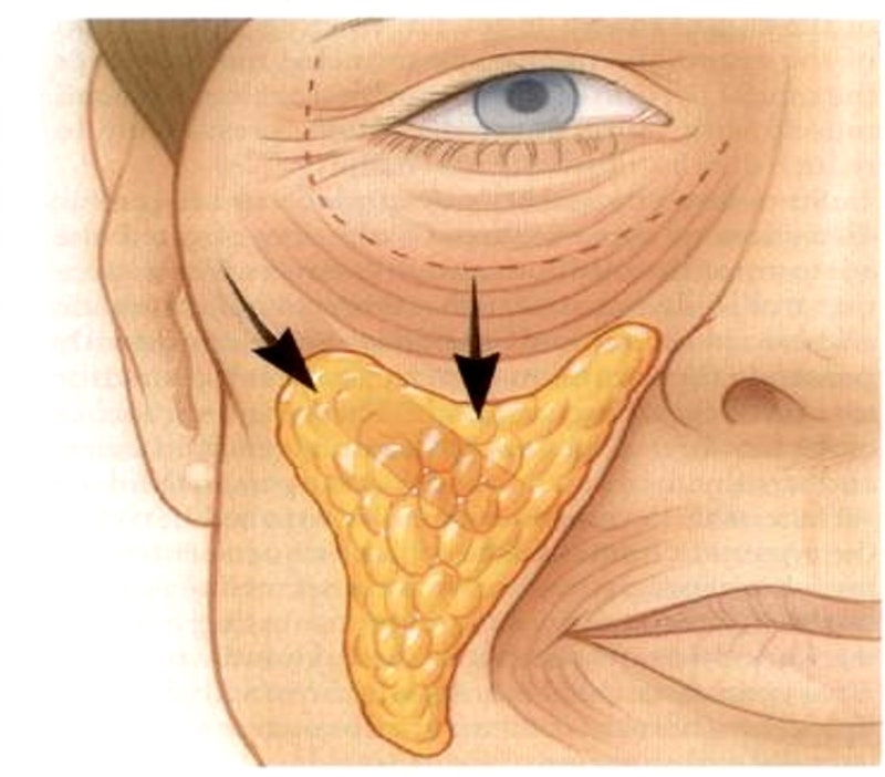 안면거상술에서 SMAS 외에 무엇을 함께 봐야 하는가 - Integrated Tissue Control | 테일러성형외과 사진 2
