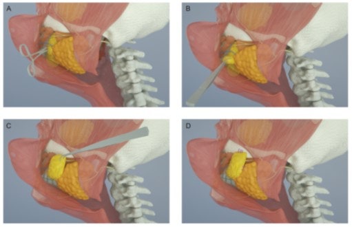 안면거상술에서 SMAS 외에 무엇을 함께 봐야 하는가 - Integrated Tissue Control | 테일러성형외과 사진 3