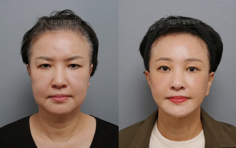 안면거상술에서 SMAS 외에 무엇을 함께 봐야 하는가 - Integrated Tissue Control | 테일러성형외과