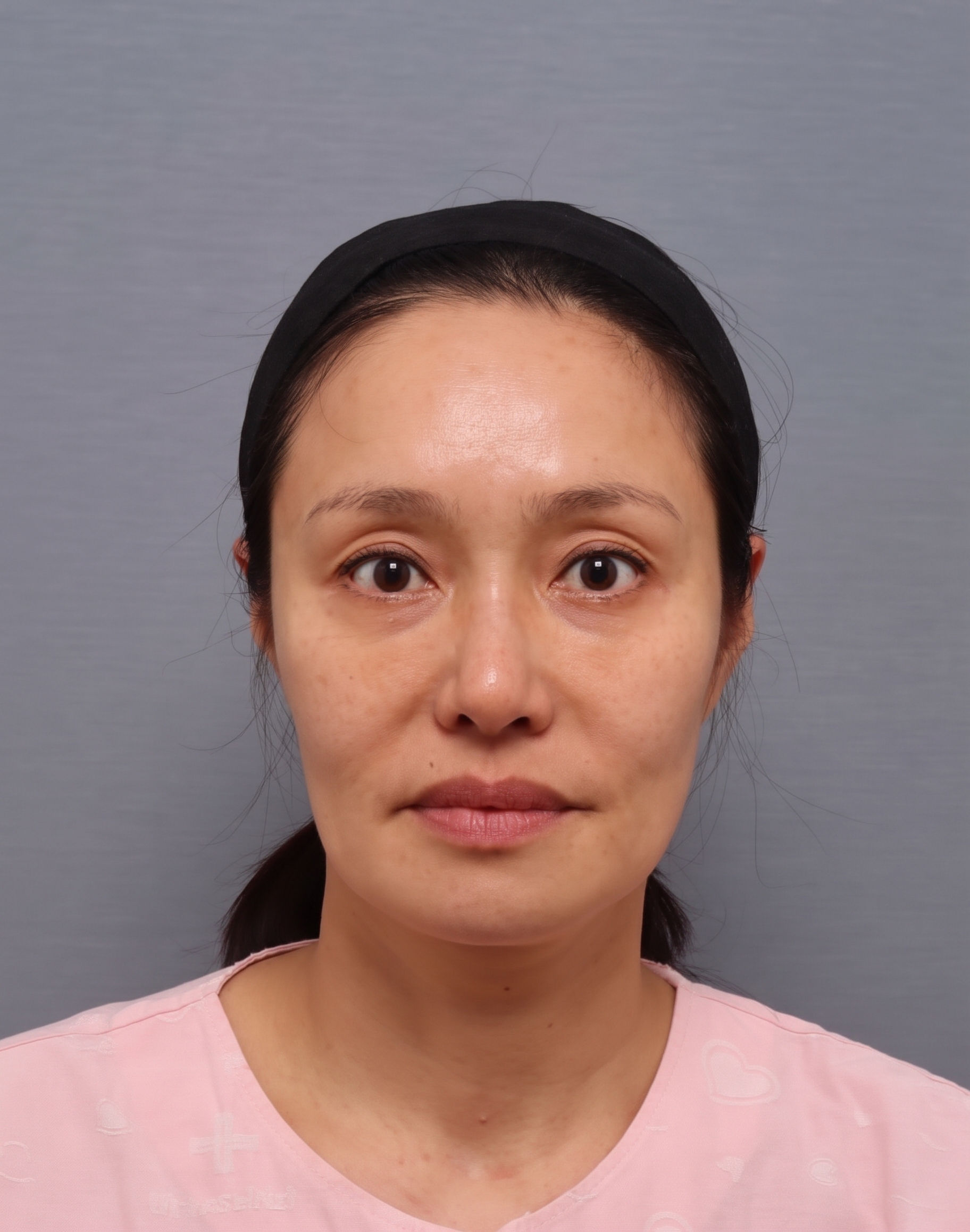 臉部拉皮重修手術,與初次手術有何不同?—重修手術難度更高的原因 | 泰勒整形外科 사진 3