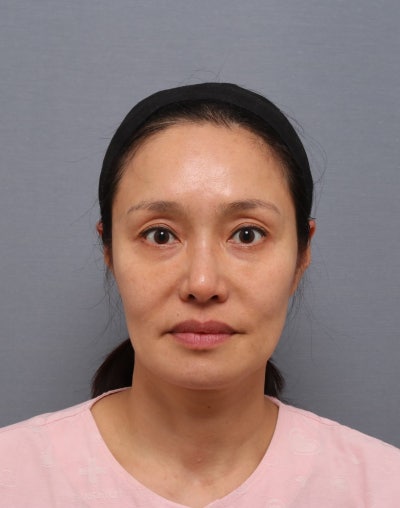 안면거상 재수술, 처음 수술과 무엇이 다를까요? — 재수술이 더 어려운 이유 | 테일러성형외과 사진 3