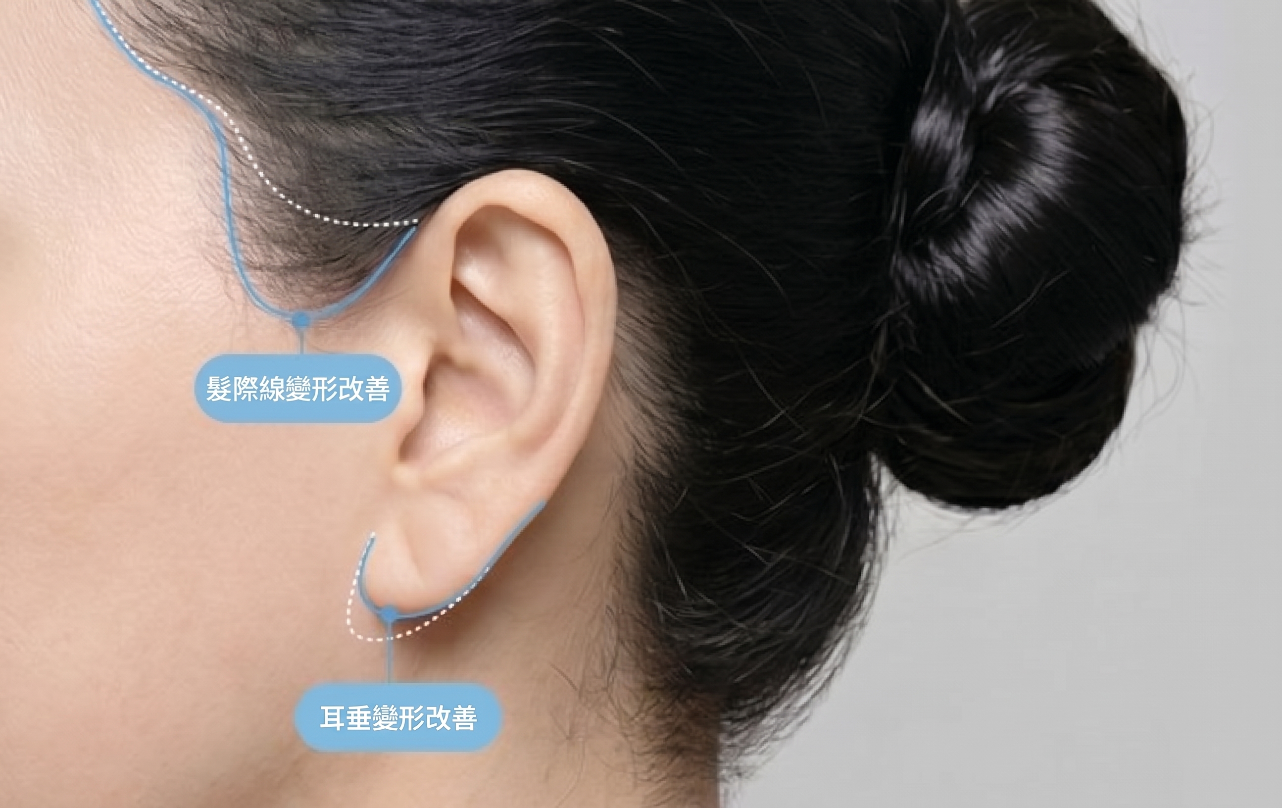 臉部拉皮重修手術,與初次手術有何不同?—重修手術難度更高的原因 | 泰勒整形外科 사진 5