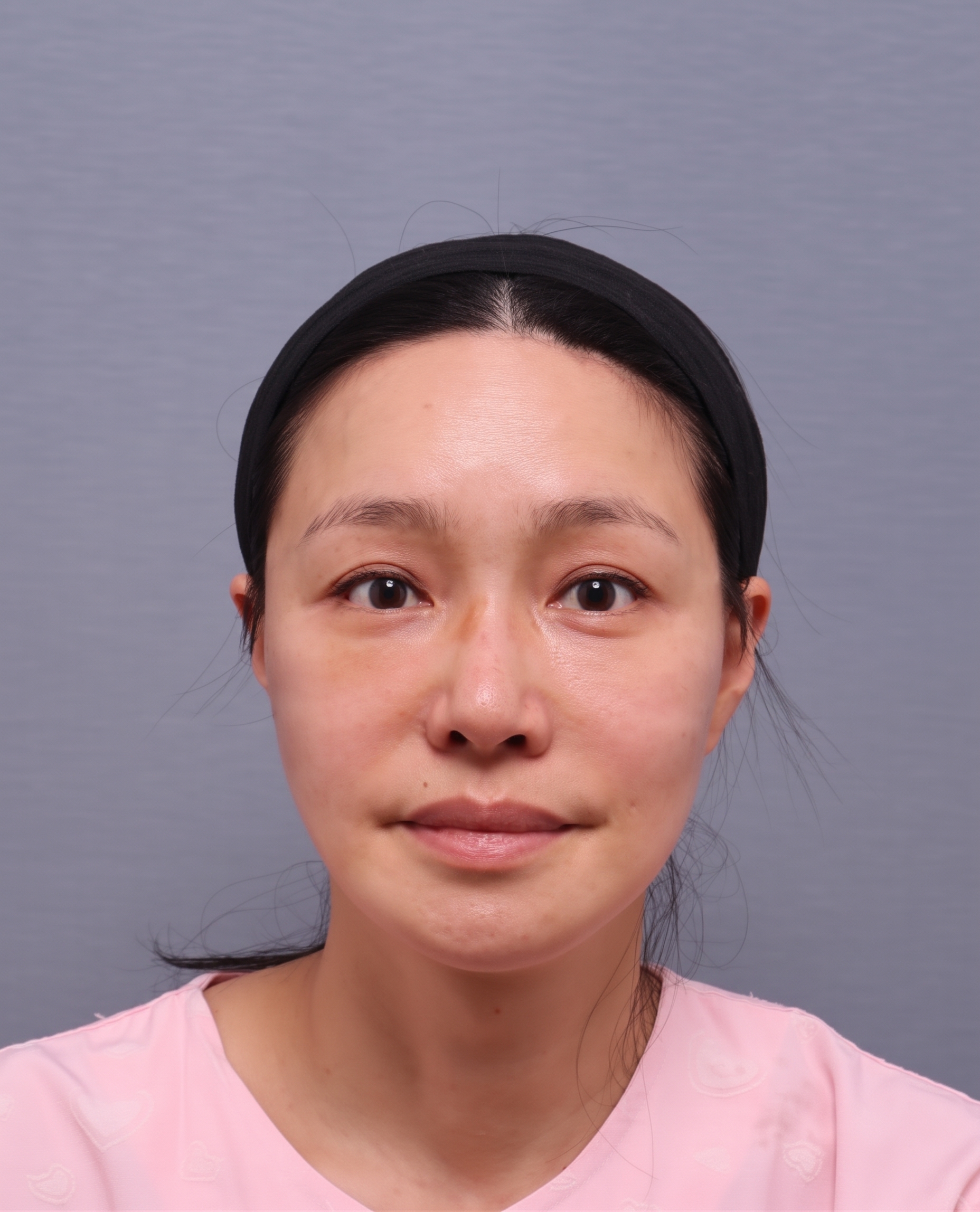 切開リフト（フェイスリフト）再手術、初回の手術と何が違うのか？—再手術がより難易度が高い理由 | テイラー美容外科 사진 4
