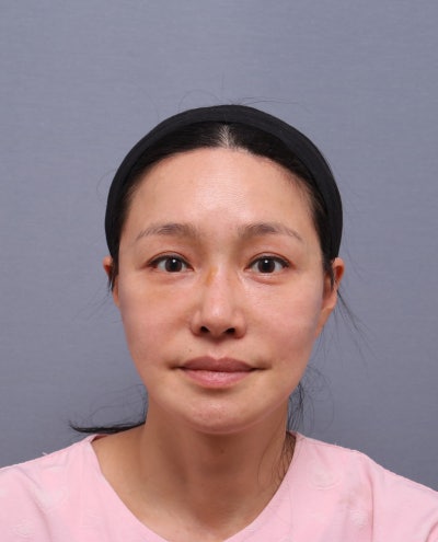 안면거상 재수술, 처음 수술과 무엇이 다를까요? — 재수술이 더 어려운 이유 | 테일러성형외과 사진 4
